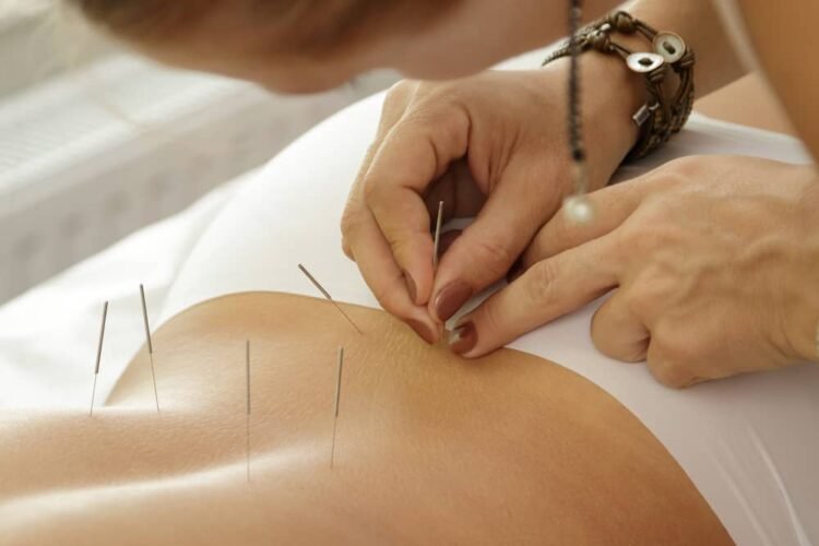 acupuncture for lower back pain