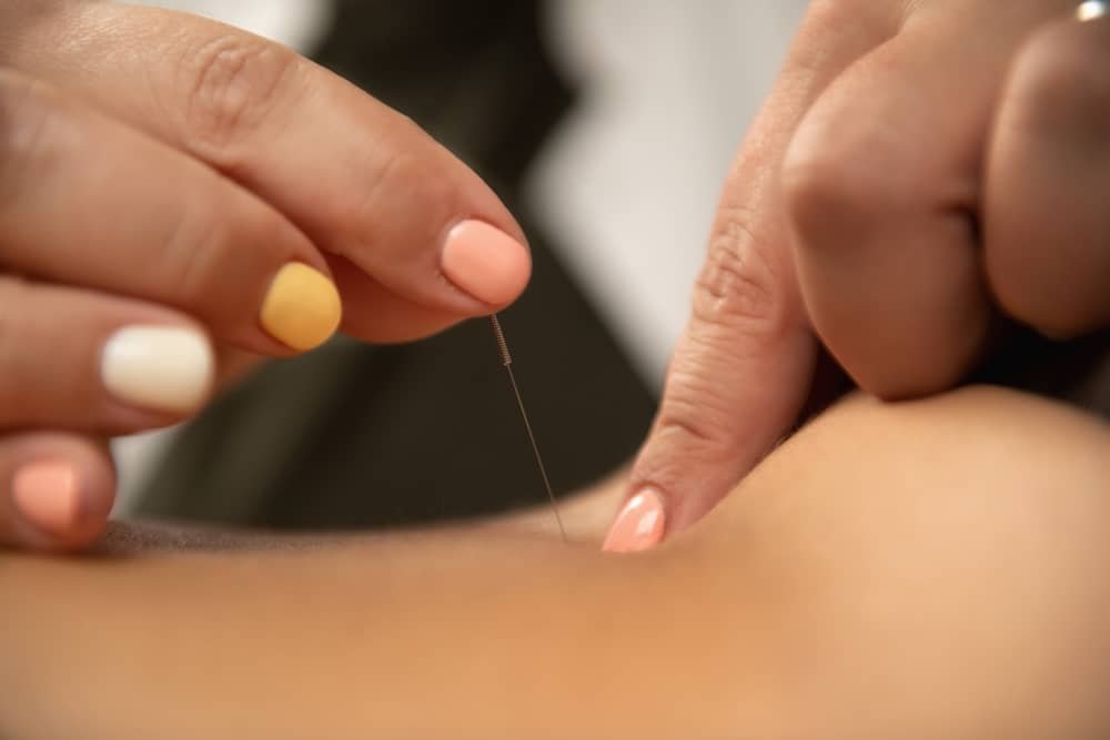 Acupuncture for lower back pain Edmonton