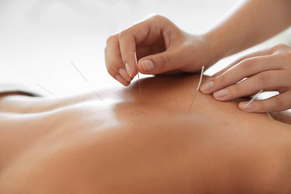 acupuncture for back pain in Edmonton