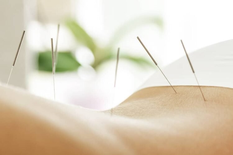 acupuncture for lower back pain Edmonton