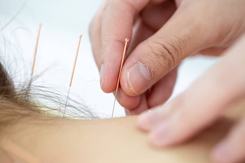 acupuncture for neck pain Edmonton