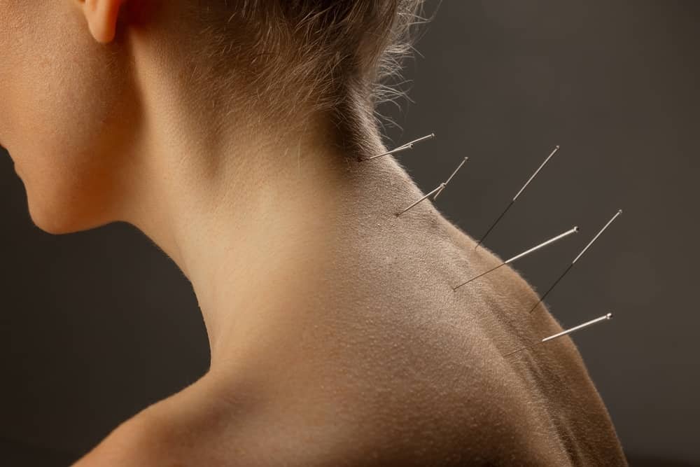 acupuncture for neck pain Edmonton