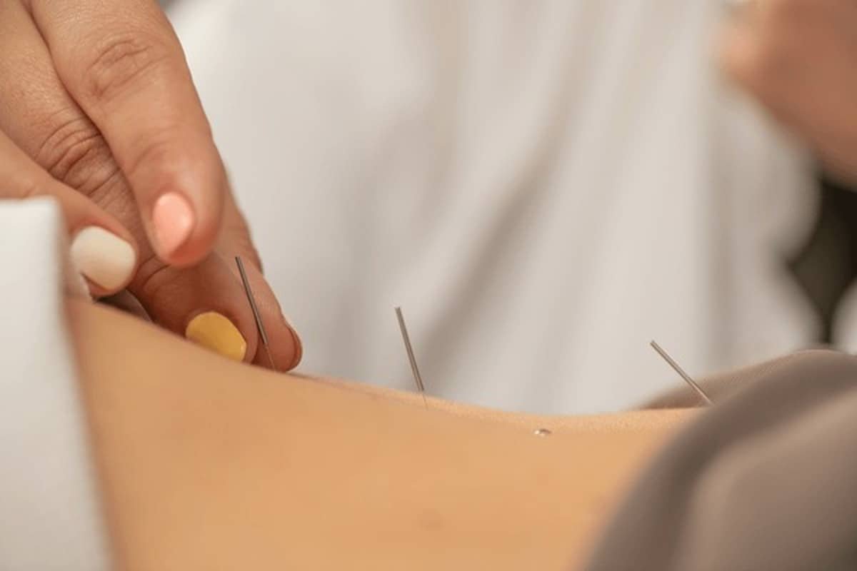 Acupuncture for back pain Edmonton