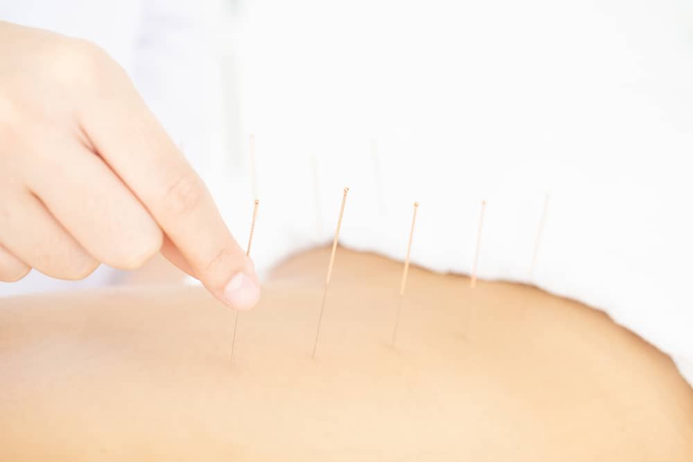 Acupuncture for lower back pain Edmonton
