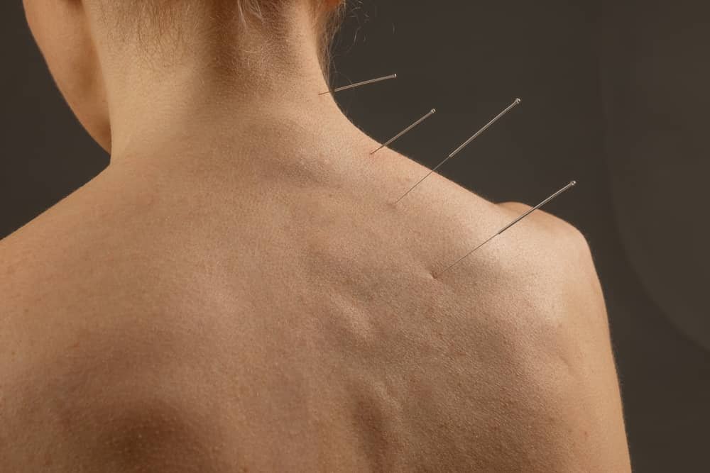 acupuncture for neck pain Edmonton