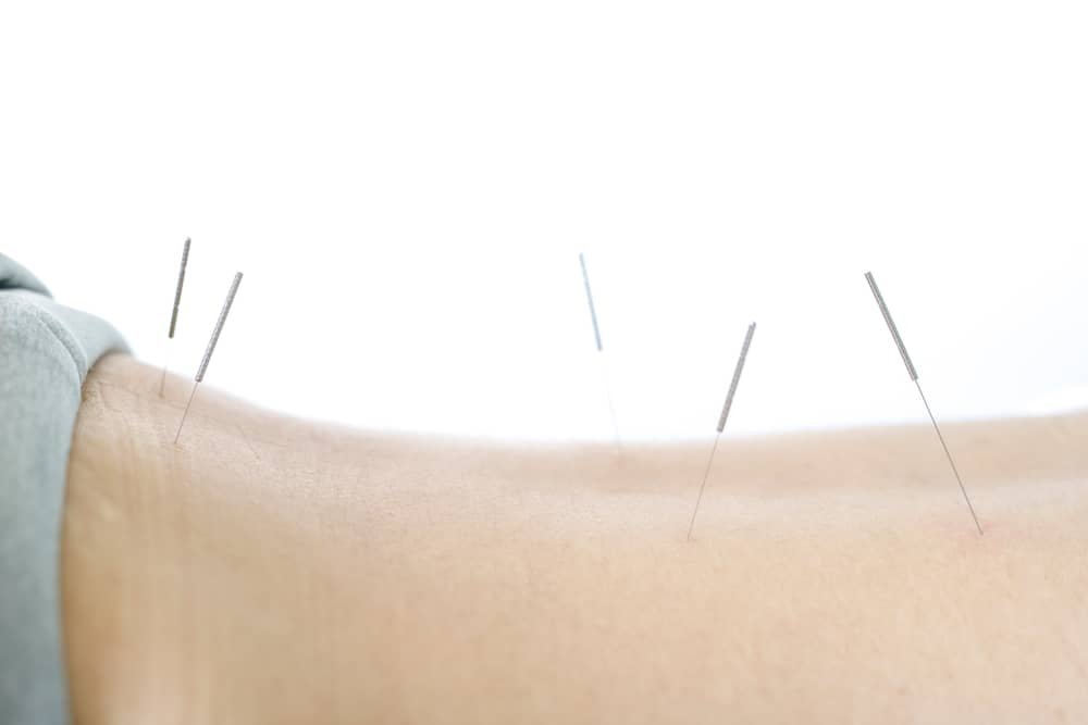 Try Acupuncture if Self-Care Isn't Helping Lower Back Pain