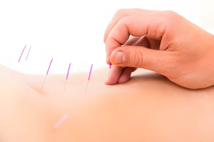 Practitioner providing acupuncture treatment for back pain at a clinic in Edmonton